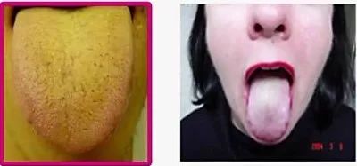 湿气重吃什么祛湿排毒好,健康生活与常见疾病预防