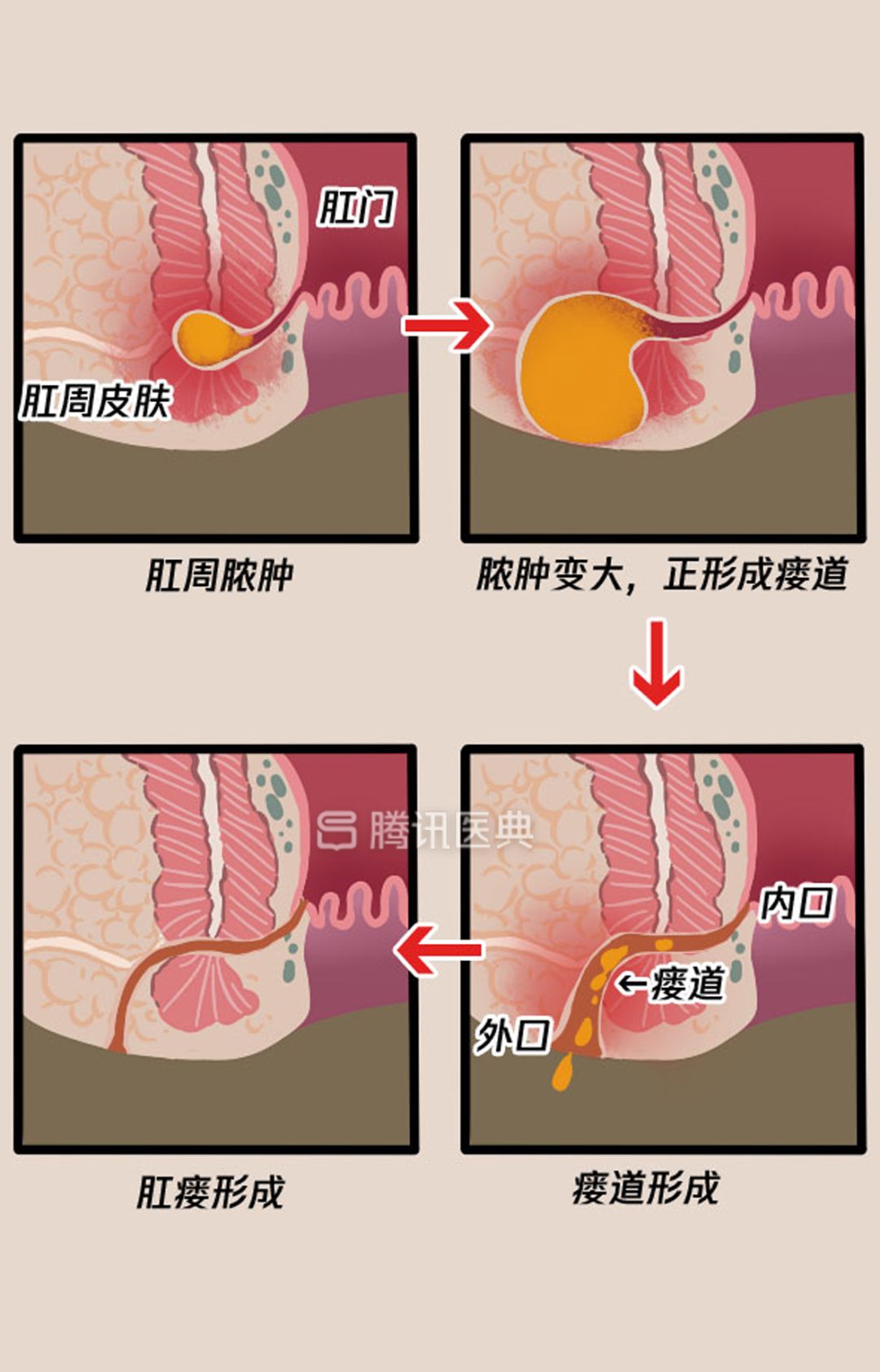 “*菊爆**后”痛到喊妈！真实看病经历泣血奉上，必须保护好菊花！