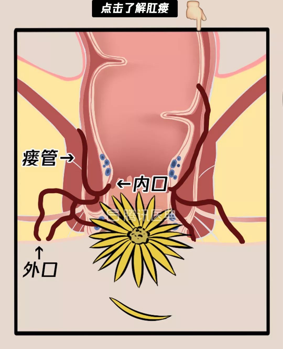 “*菊爆**后”痛到喊妈！真实看病经历泣血奉上，必须保护好菊花！