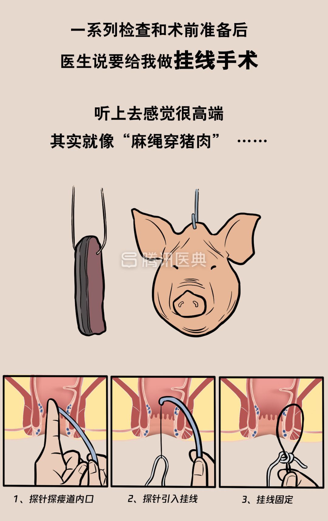 “*菊爆**后”痛到喊妈！真实看病经历泣血奉上，必须保护好菊花！