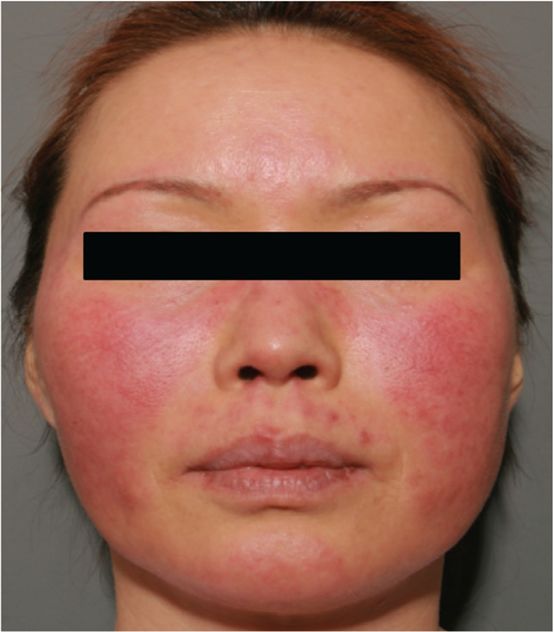 面部皮疹是什么原因引起的,全身皮疹伴有关节疼痛