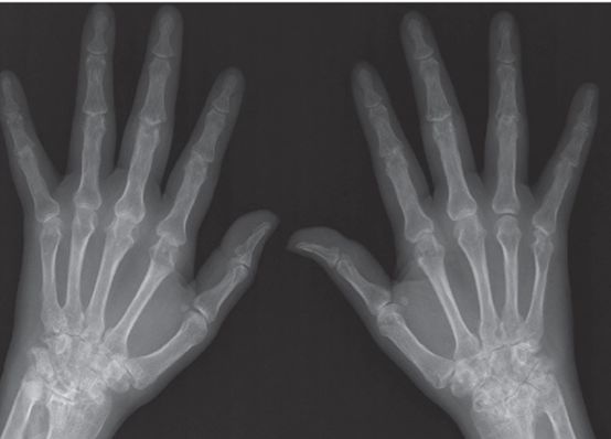 面部皮疹是什么原因引起的,全身皮疹伴有关节疼痛