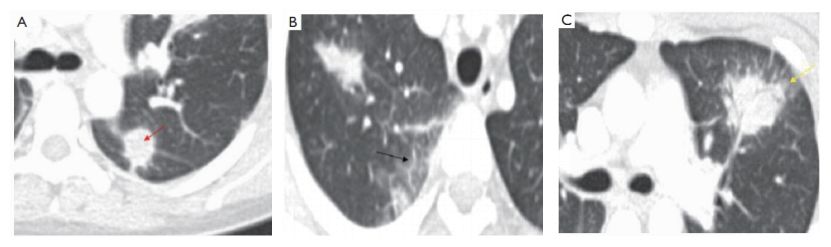 igg4相关性疾病中医辨证论治,igg4相关性眼病最新研究成果