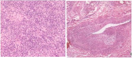 igg4相关性疾病中医辨证论治,igg4相关性眼病最新研究成果