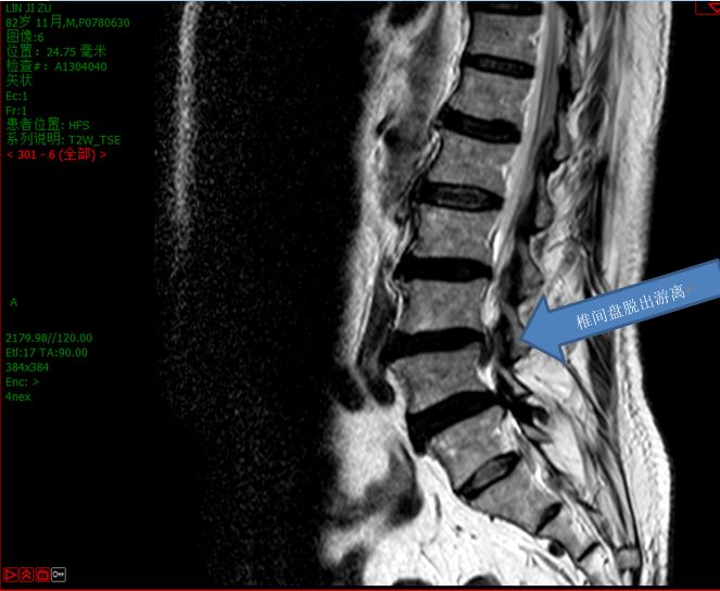 老年人腰椎间盘突出吃什么药止痛,老年人腰椎间盘突出压迫神经腿疼