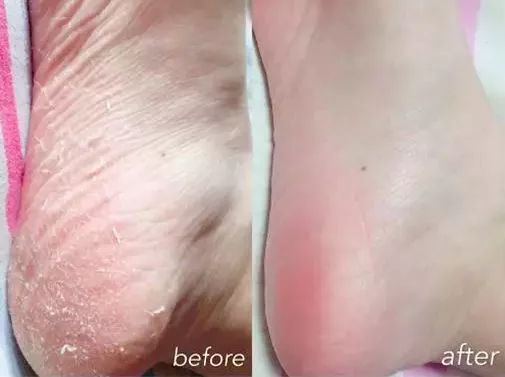 娇嫩双足|堪比“换皮术”的逆天足膜！让双脚像剥鸡蛋壳一样轻松换新皮！60分钟还你柔嫩美足