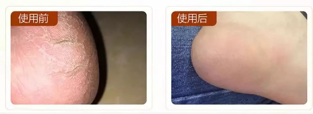 治脚气的抗真菌偏方,角化型脚气干裂最好的药