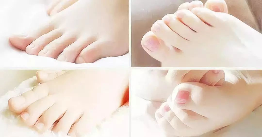 治脚气的抗真菌偏方,角化型脚气干裂最好的药