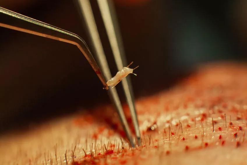 华西医院皮肤科脱发专家排名,四川华西医院脱发治得好吗