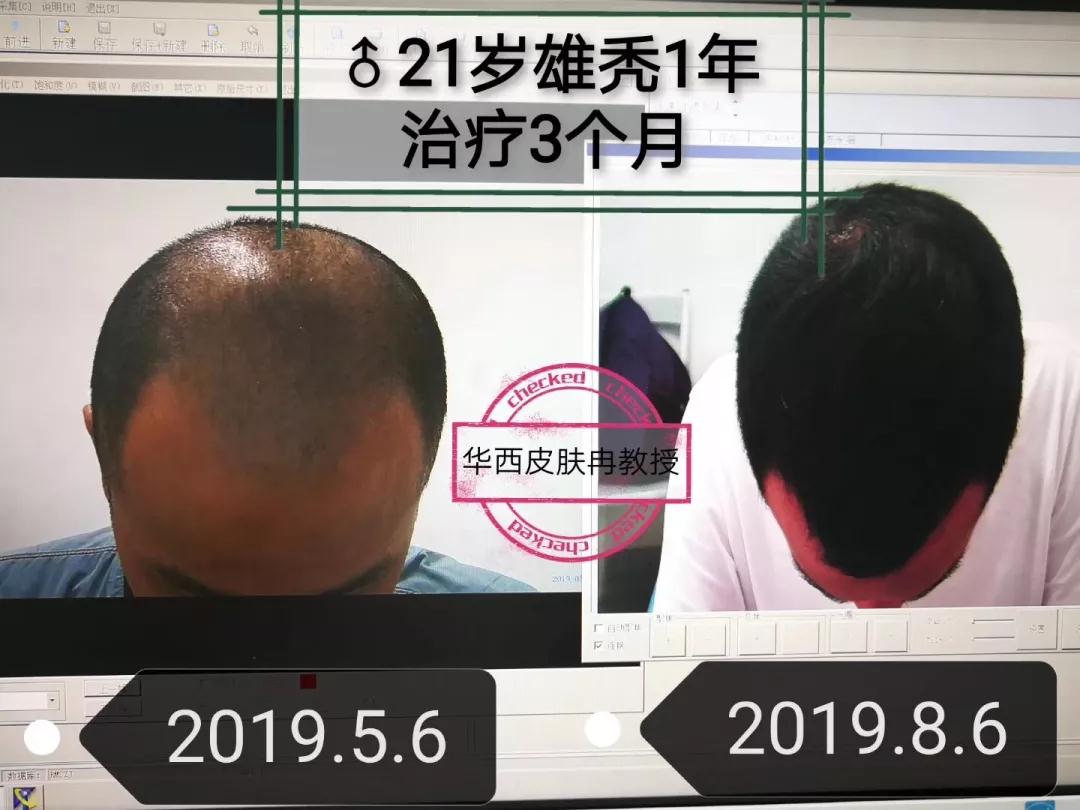 华西医院皮肤科脱发专家排名,四川华西医院脱发治得好吗