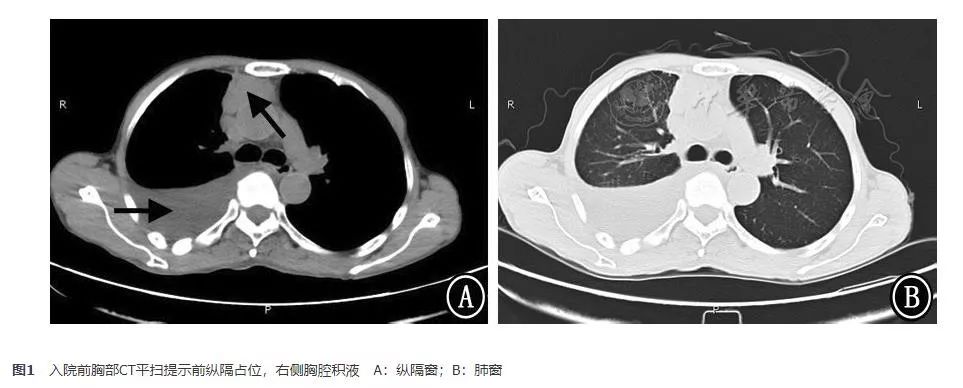 胸腺鳞癌一例并文献复习