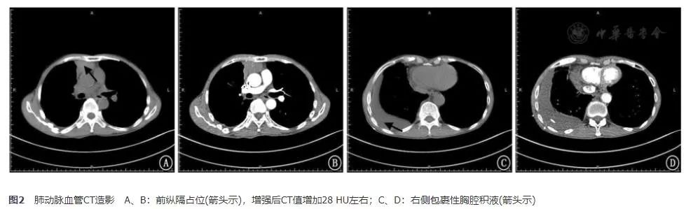 胸腺鳞癌一例并文献复习