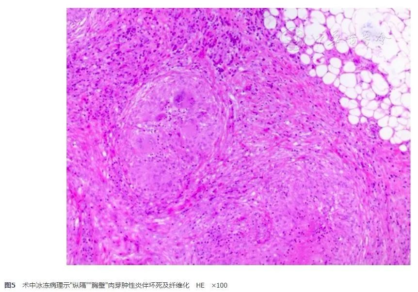 胸腺鳞癌一例并文献复习