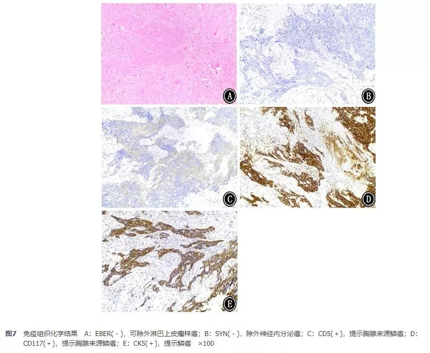 胸腺鳞癌一例并文献复习