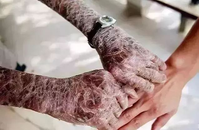 让人瞠目结舌的另类吸毒方式：塞肛门、抹神油、贴膏药……