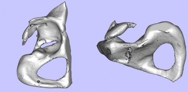 攀枝花三帝科技：3D打印助力髋关节患者骨盆修复