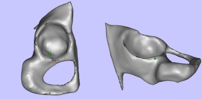 攀枝花三帝科技：3D打印助力髋关节患者骨盆修复