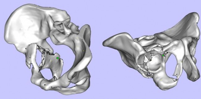 攀枝花三帝科技：3D打印助力髋关节患者骨盆修复