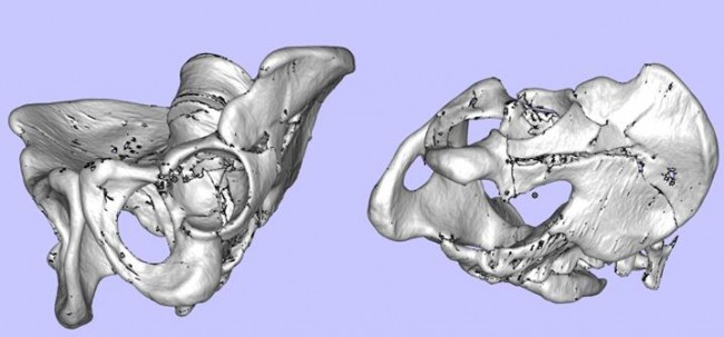 攀枝花三帝科技：3D打印助力髋关节患者骨盆修复