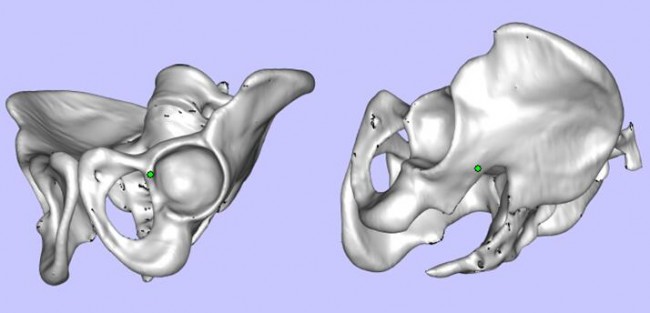 攀枝花三帝科技：3D打印助力髋关节患者骨盆修复