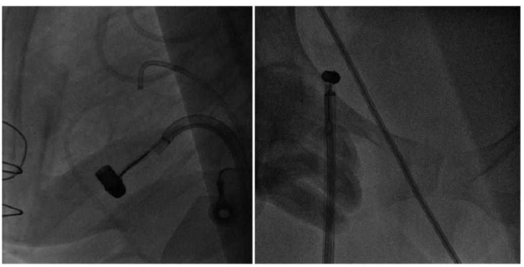 *弹子**栓塞：一波三折的取弹经历｜病例“心”编