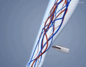 心脏造影和支架一起做大概多少钱,心脏造影支架视频全过程