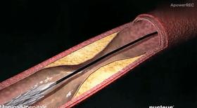 心脏造影和支架一起做大概多少钱,心脏造影支架视频全过程