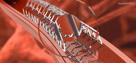 心脏造影和支架一起做大概多少钱,心脏造影支架视频全过程