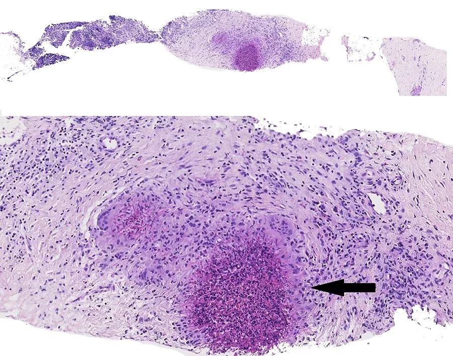 炎症性肠病最主要的症状是,肠肉芽肿性炎是什么病