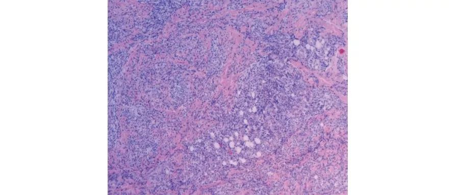 炎症性肠病最主要的症状是,肠肉芽肿性炎是什么病