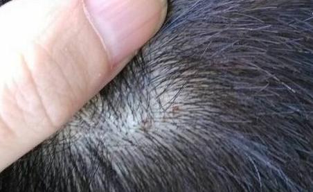 头皮上长小疙瘩怎么回事,头皮上总是起小疙瘩怎么办