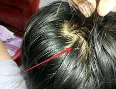 头皮上长小疙瘩怎么回事,头皮上总是起小疙瘩怎么办