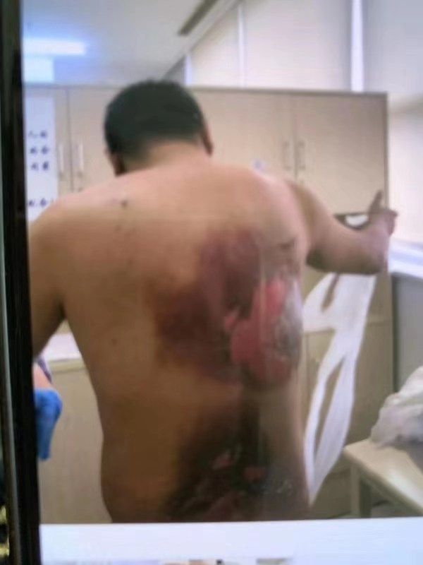 男子被泼液体引燃致烧伤,男子身上着火被消防员扑灭烧伤