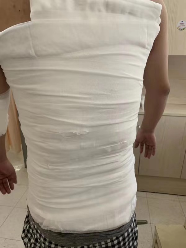 男子被泼液体引燃致烧伤,男子身上着火被消防员扑灭烧伤