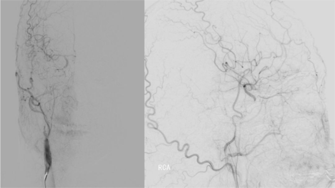颈内动脉闭塞先进治疗,颈内动脉闭塞开通术病例讨论