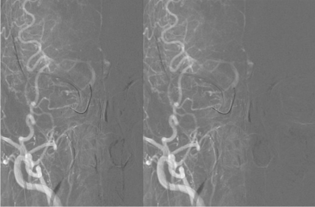 颈内动脉闭塞先进治疗,颈内动脉闭塞开通术病例讨论