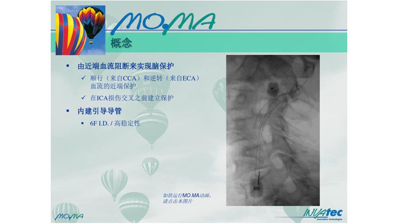 颈内动脉闭塞先进治疗,颈内动脉闭塞开通术病例讨论