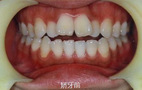 牙齿矫正新措施落地福州,福州牙齿矫正免费领取