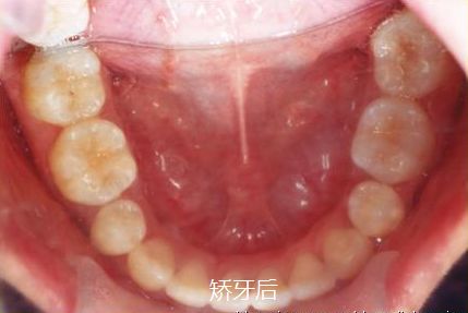 牙齿矫正新措施落地福州,福州牙齿矫正免费领取