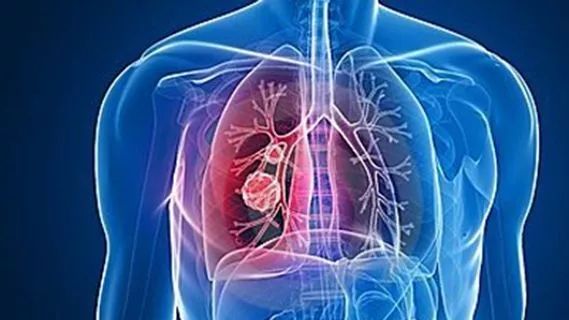 肺部肿瘤切除手术四天内出院？