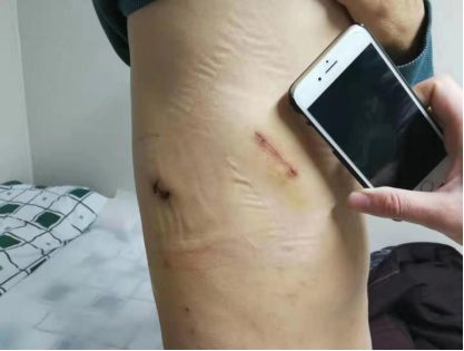 肺部肿瘤切除手术四天内出院？