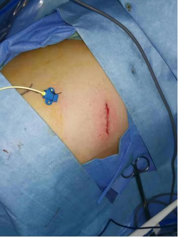 肺部肿瘤切除手术四天内出院？