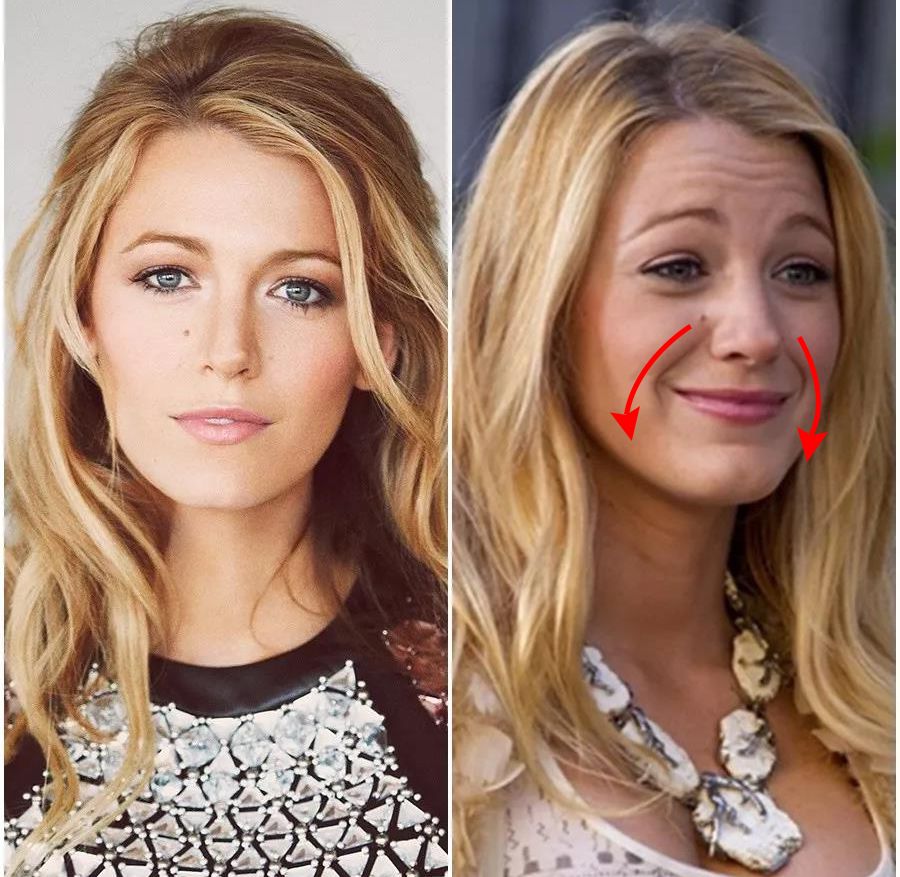 消除眉间法令纹最有效的方法,眉间纹和法令纹医美