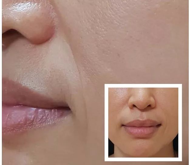 消除眉间法令纹最有效的方法,眉间纹和法令纹医美