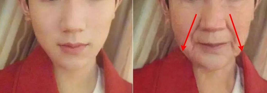 消除眉间法令纹最有效的方法,眉间纹和法令纹医美