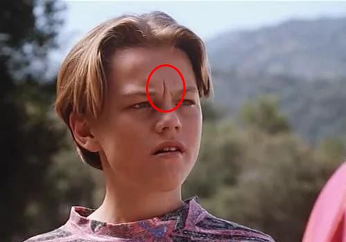 消除眉间法令纹最有效的方法,眉间纹和法令纹医美