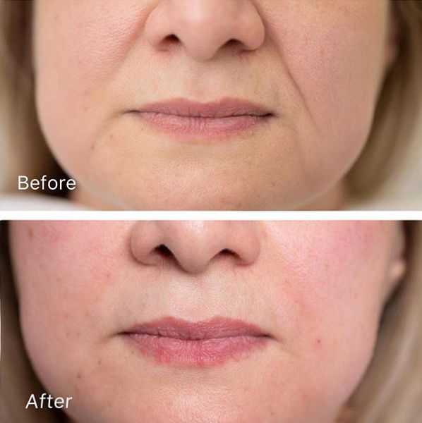 消除眉间法令纹最有效的方法,眉间纹和法令纹医美