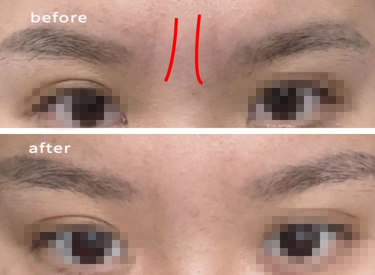 消除眉间法令纹最有效的方法,眉间纹和法令纹医美