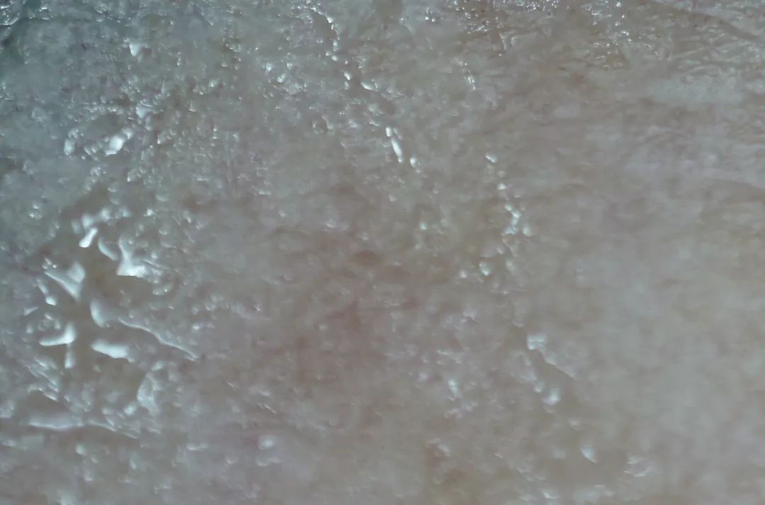 消除眉间法令纹最有效的方法,眉间纹和法令纹医美