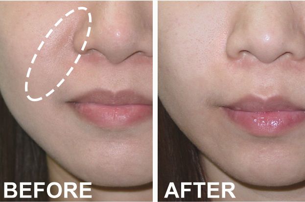 消除眉间法令纹最有效的方法,眉间纹和法令纹医美